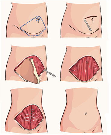 Abdominoplastia